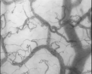Microvascular (blood) image observation instrument